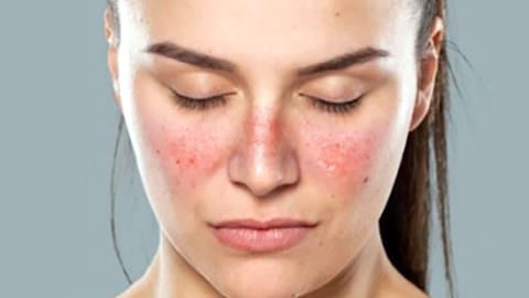 ¿Podemos comprender y tratar el lupus?