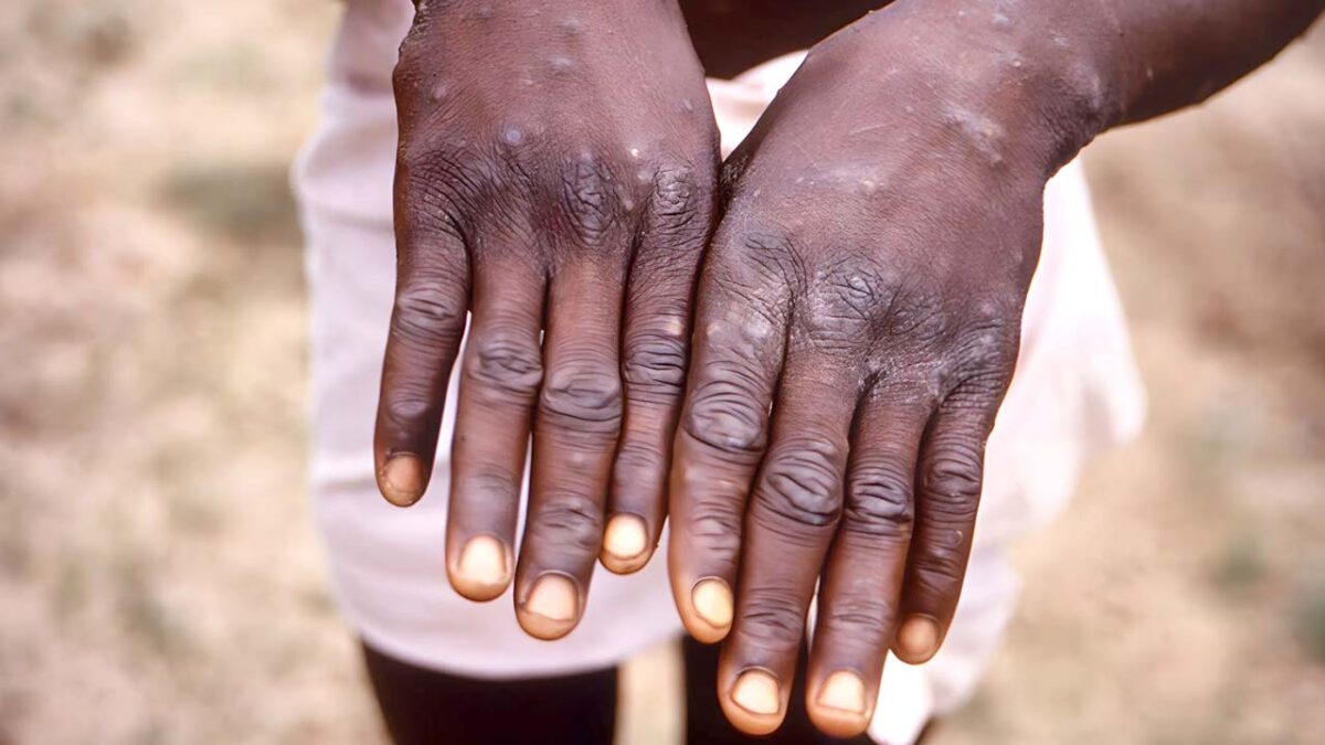 ¿Qué hay que saber sobre la viruela símica?